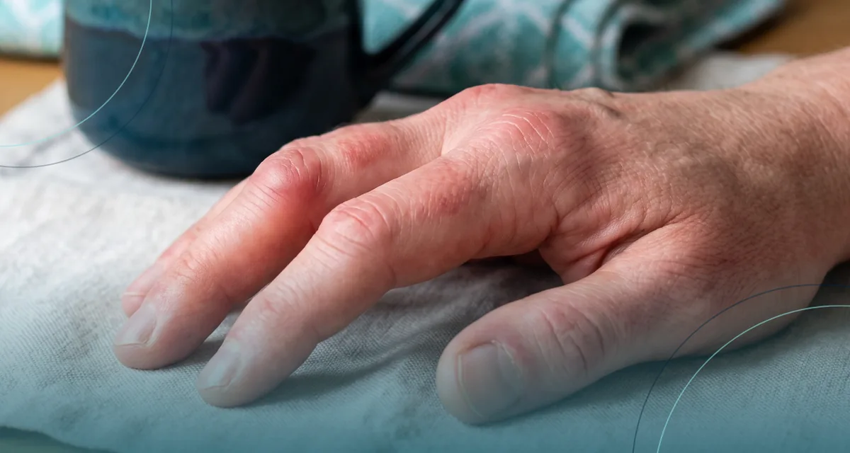 Close-up of a red, swollen hand resting on a white towel